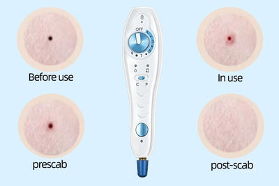 Professional Plasma Pen Plamax Cold Plasma Wireless Skin Tightly Acne Treatment