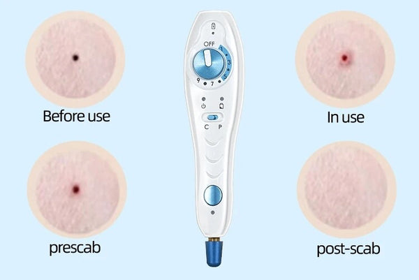 Professional Plasma Pen Plamax Cold Plasma Wireless Skin Tightly Acne Treatment