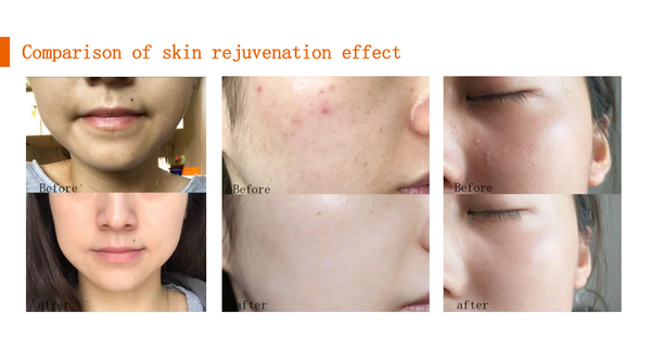 3IN1 OPT IPL RF Tattoo And Hair Removal ND YAG Laser Skin Rejuvenation Machine