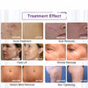 2IN1 Fractional Radiofrequency Gold-RF Beauty Machine Cold Hammer Acne Removal