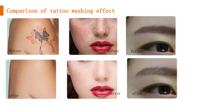 3IN1 OPT IPL RF Tattoo And Hair Removal ND YAG Laser Skin Rejuvenation Machine