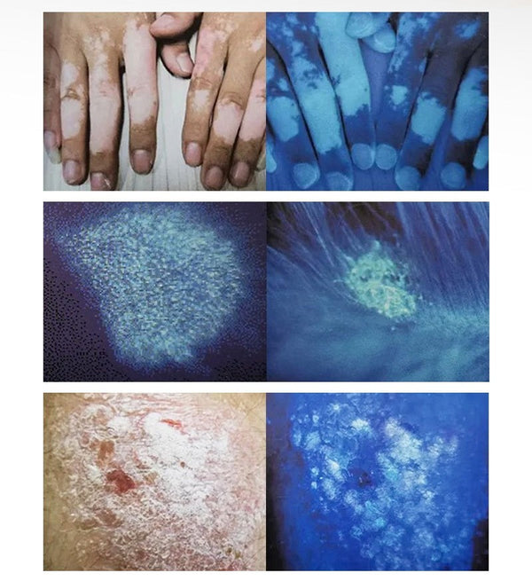 Dermatology Medical LED Woods Lamp Skin Analyzer For Vitiligo Wood's Lamp Skin