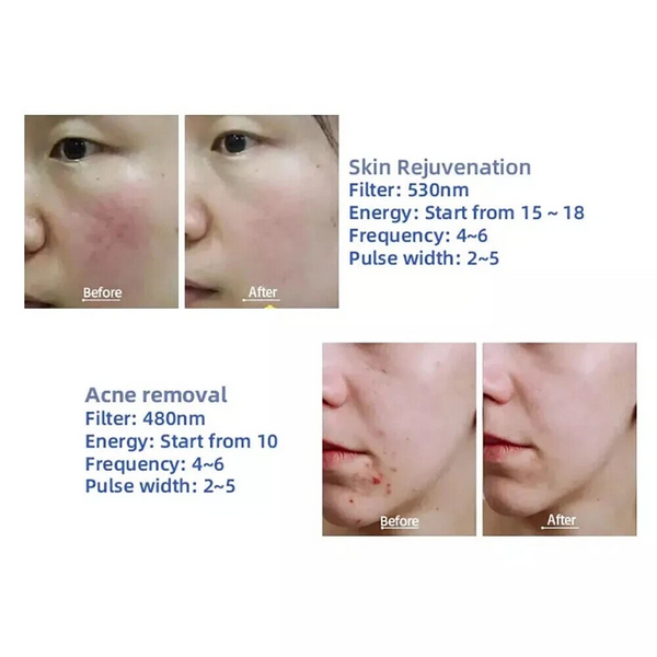 3IN1 OPT IPL RF Tattoo And Hair Removal ND YAG Laser Skin Rejuvenation Machine