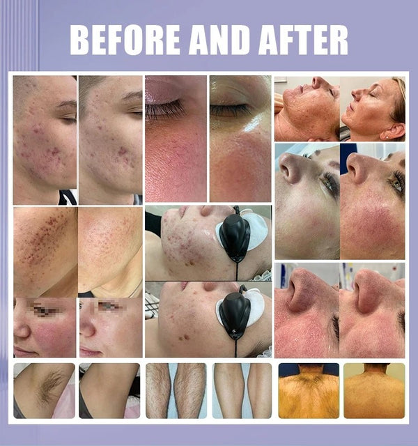 Multi-Functional IPL Photofacial Beauty Machine Nd Yag Laser Handle forSkin Care