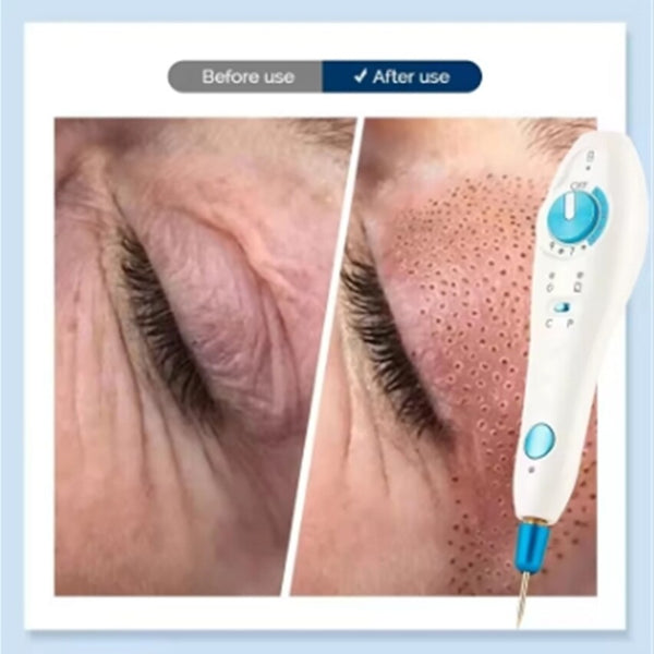 Professional Plasma Pen Plamax Cold Plasma Wireless Skin Tightly Acne Treatment