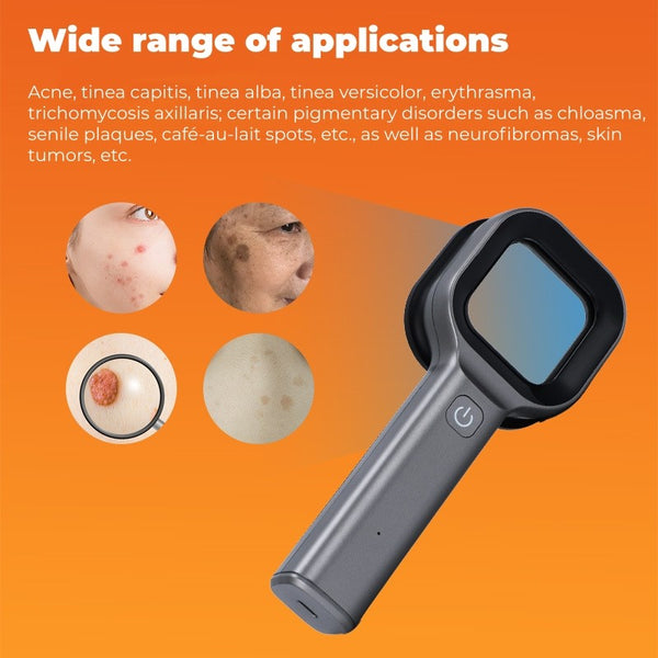 Dermatology Medical LED Woods Lamp Skin Analyzer For Vitiligo Wood's Lamp Skin