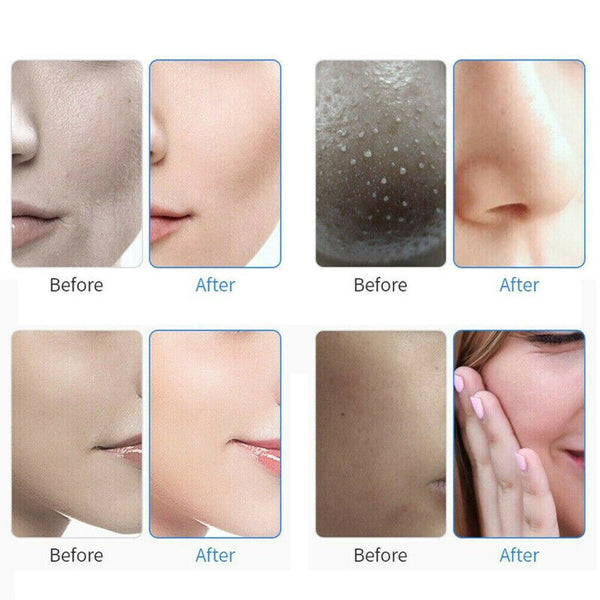 10in1 Water Dermabrasion Deep Cleansing Hydro Hydra Dermabrasion Facial Machine