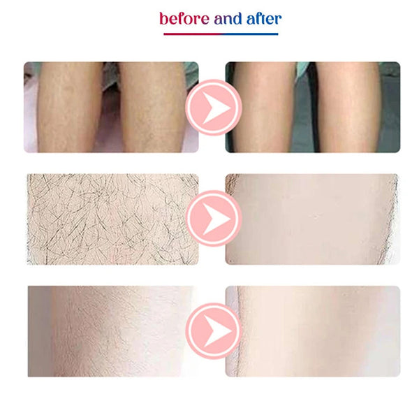 OPT 3 Wavelength Portable Hair Removal Laser Professional Painless Hair Removal