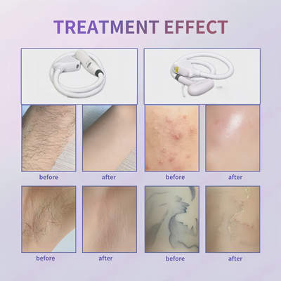 2IN1 808nm Tattoo Hair Removal Machine Diode Laser Picosecond Skin Rejuvenation