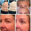 2-in-1 Vaginal Tightening Face Skin Tightening Wrinkle Scar Removal Machine AU