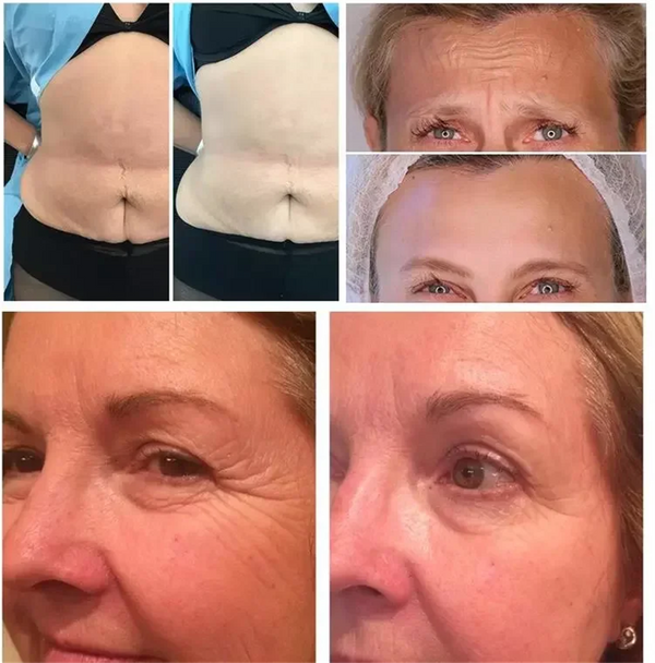 2-in-1 Vaginal Tightening Face Skin Tightening Wrinkle Scar Removal Machine AU