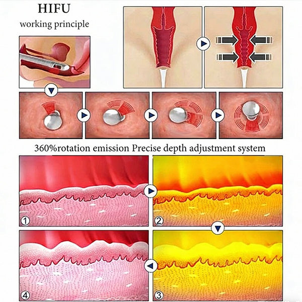 Professional Ultrasound Vaginal Tightening Machine Intensive Rejuvenation Skin