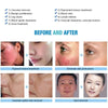 Pro 980nm Laser Spider Vein Vascular Removal Skin Rejuvenation Cold Hammer 2in1