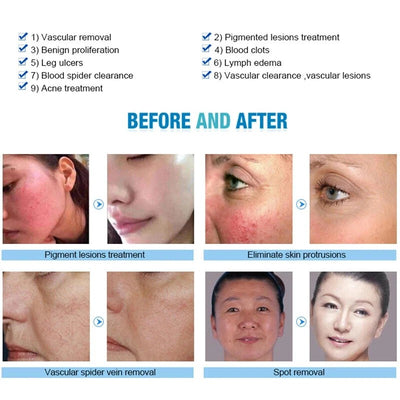 Pro 980nm Laser Spider Vein Vascular Removal Skin Rejuvenation Cold Hammer 2in1