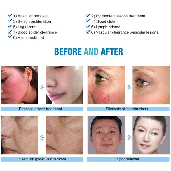 Pro 980nm Laser Spider Vein Vascular Removal Skin Rejuvenation Cold Hammer 2in1