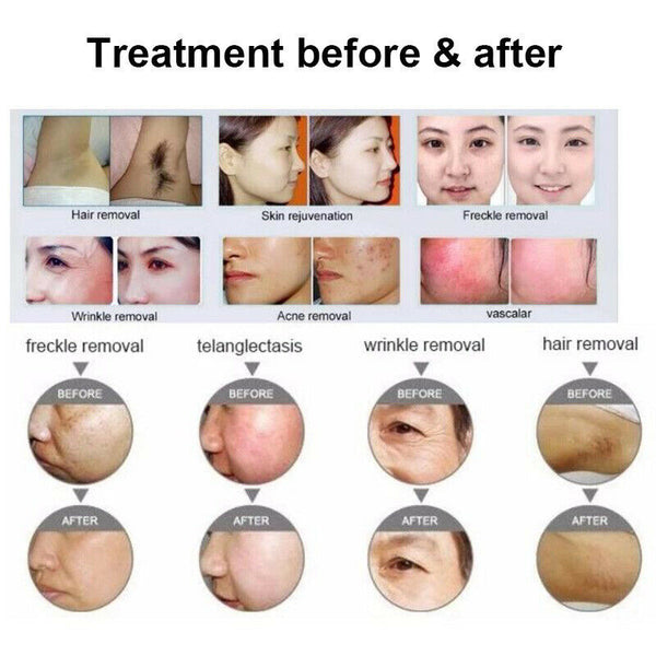 OPT 3 Wavelength Portable Hair Removal Laser Professional Painless Hair Removal
