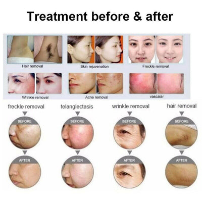 Beauty Salon IpL E Light OPT Painless Laser Permanent Hair Removal Machine